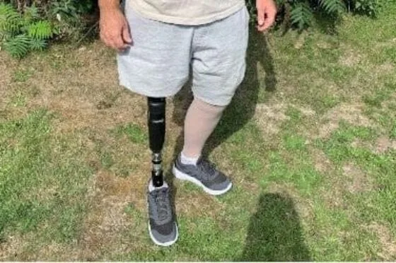 Amputee standing outdoors with prosthetic leg