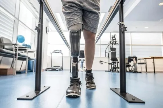 Amputee walking with prosthetic leg in gym