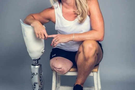 Amputee woman seated with prosthetic leg