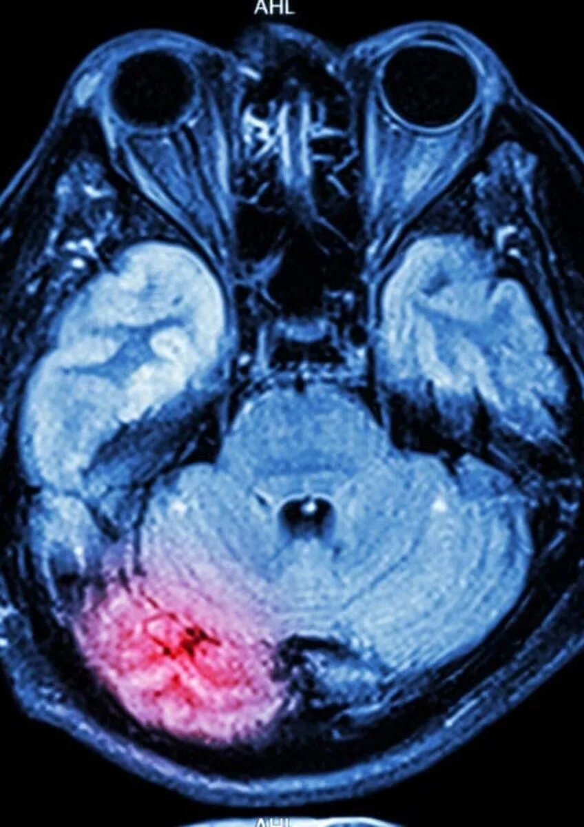 Brain scan highlighting injury