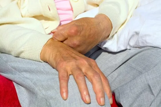 Older person's hand showing limited finger movement
