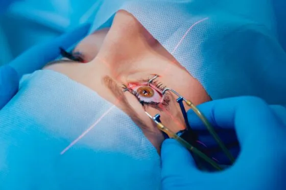 Patient undergoing eye surgery with eyelid held open and laser targeting eye