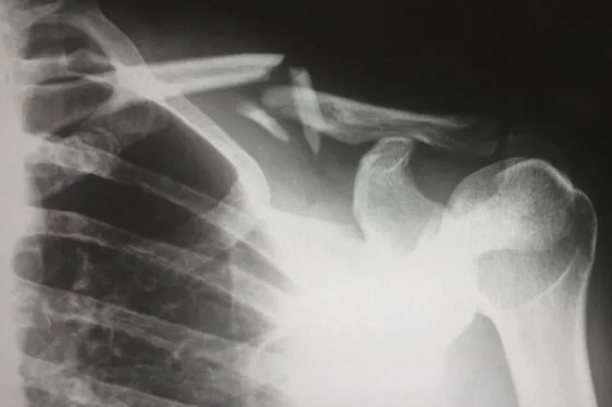 X-ray showing fractured clavicle and shoulder joint