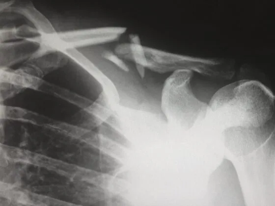 X-ray showing fractured clavicle and shoulder joint