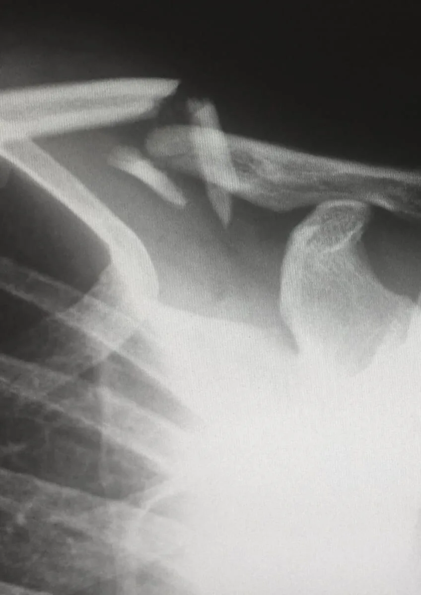X-ray showing fractured clavicle and shoulder joint