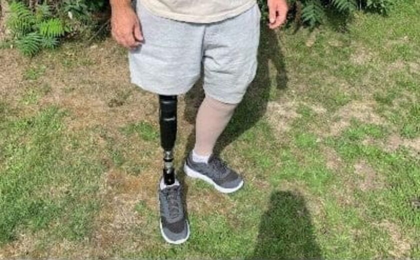 Amputee standing outdoors with prosthetic leg