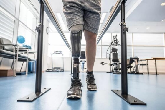 Amputee walking with prosthetic leg in gym