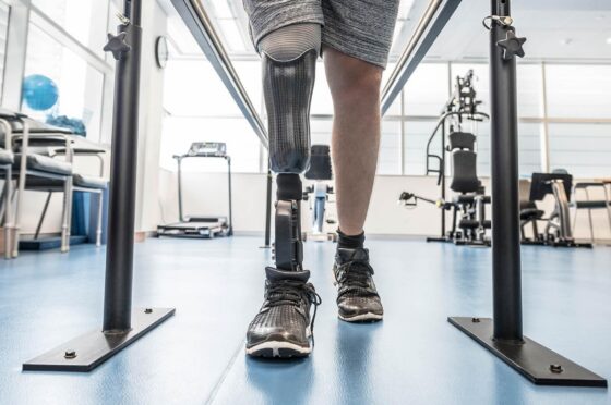 Amputee walking with prosthetic leg in rehabilitation gym