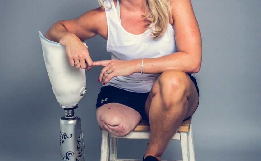 Amputee woman seated with prosthetic leg