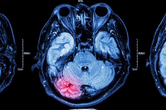 Brain scan highlighting injury