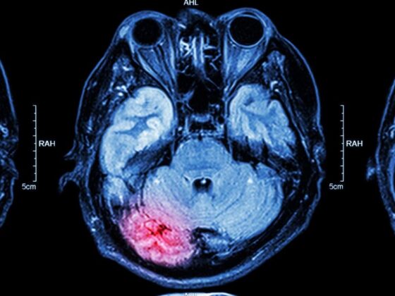 Brain scan highlighting injury