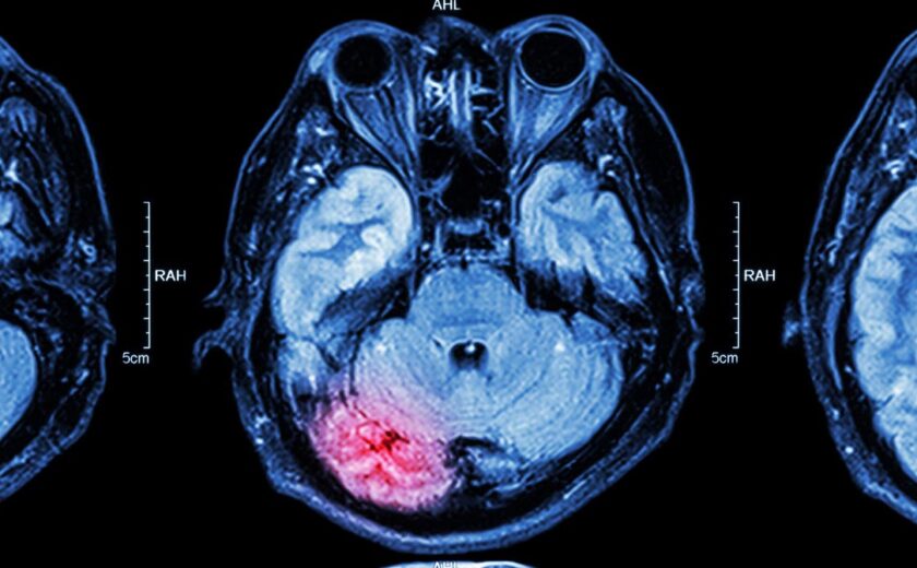 Brain scan highlighting injury