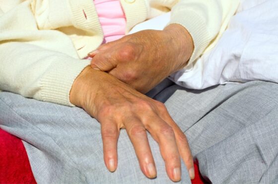 Older person's hand showing limited finger movement