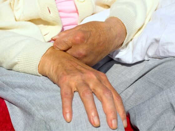 Older person's hand showing limited finger movement