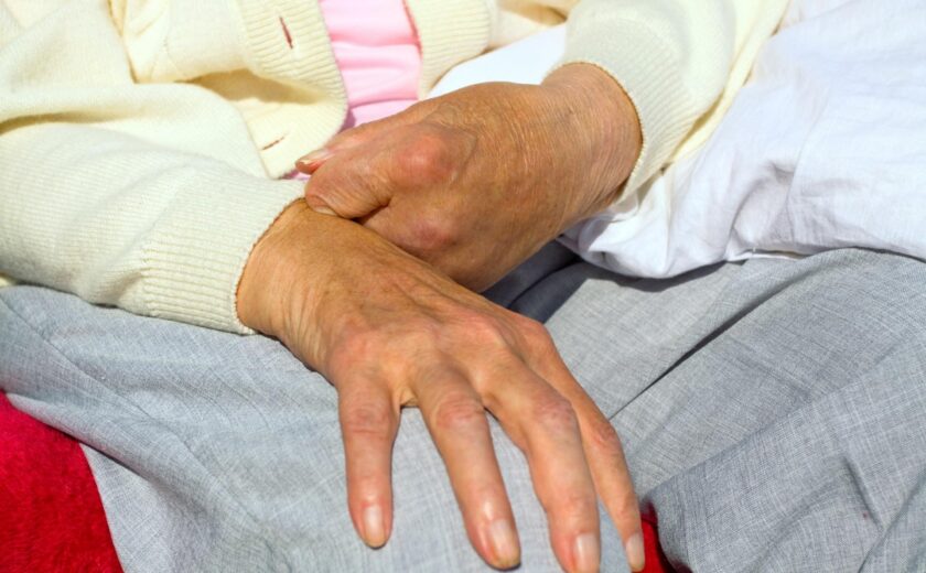 Older person's hand showing limited finger movement