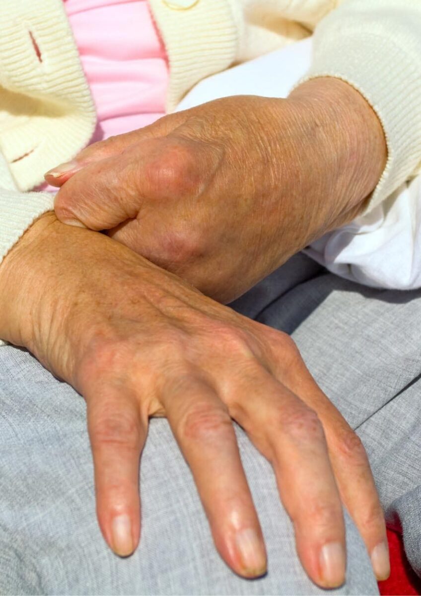 Older person's hand showing limited finger movement