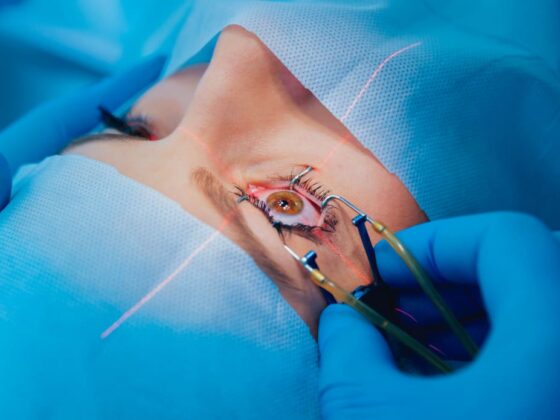 Patient undergoing eye surgery with eyelid held open and laser targeting eye