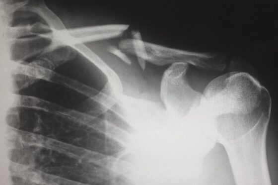 X-ray showing fractured clavicle and shoulder joint