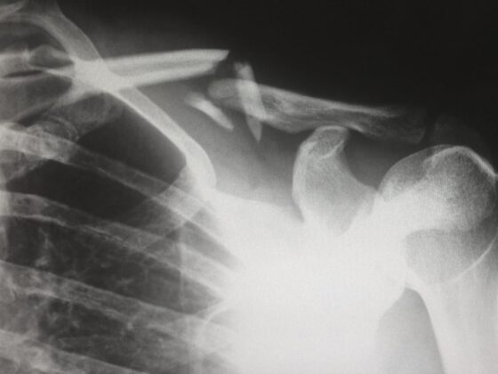X-ray showing fractured clavicle and shoulder joint