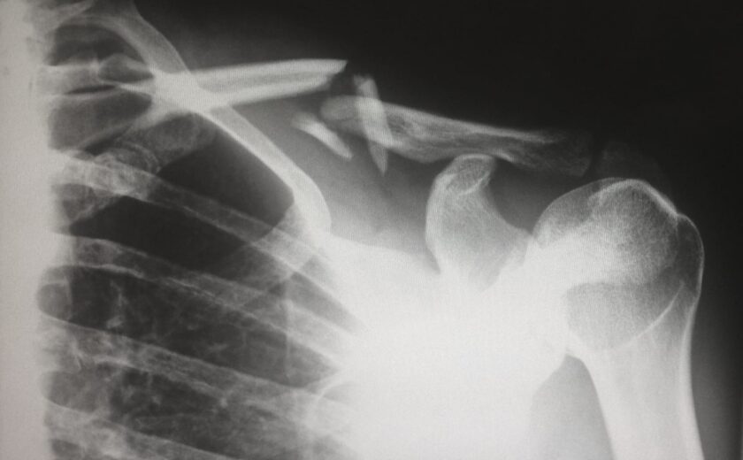 X-ray showing fractured clavicle and shoulder joint