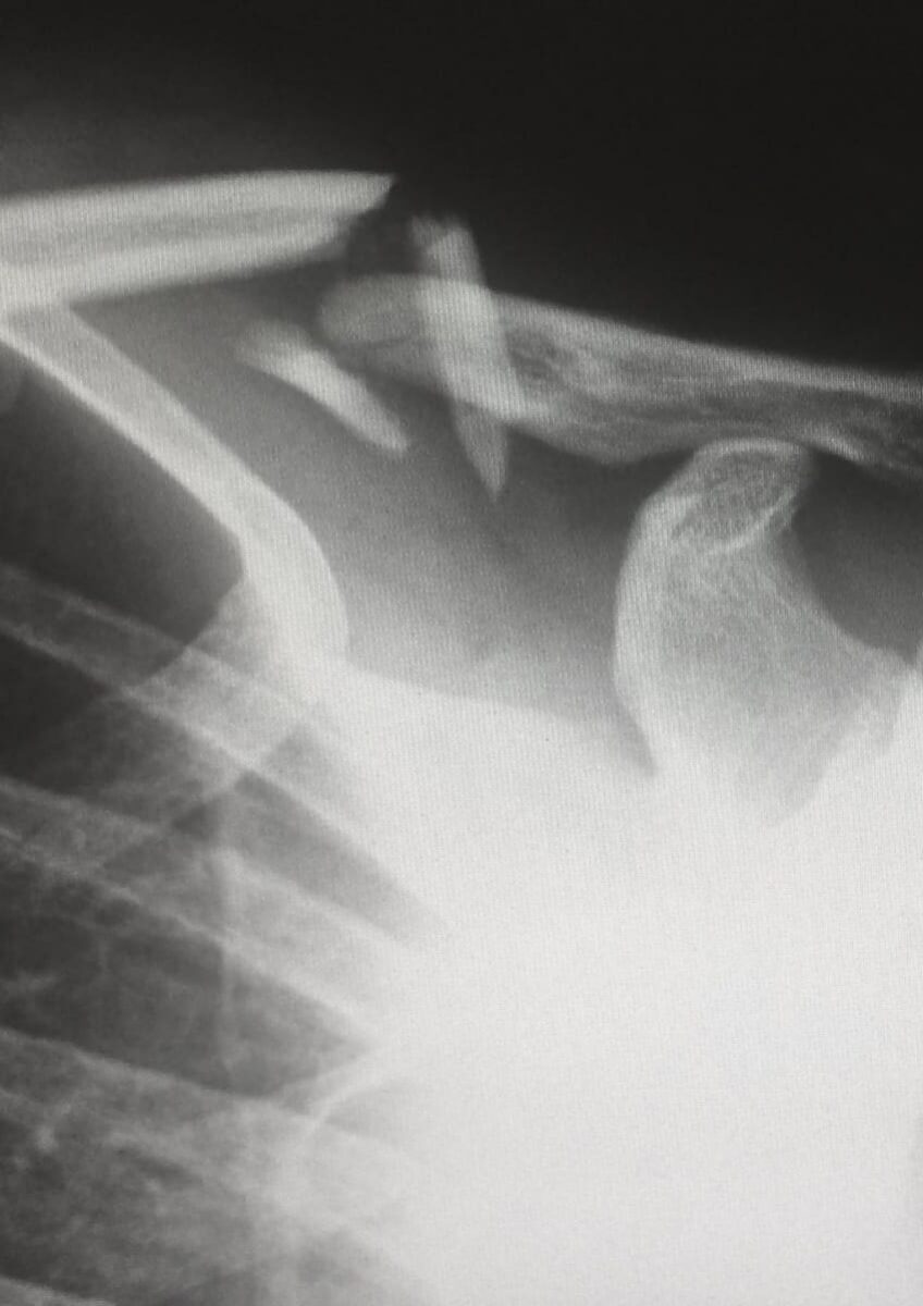 X-ray showing fractured clavicle and shoulder joint